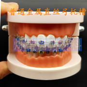 牙科牙模型正畸对比正畸讲解模型医患沟通教学牙模齿科