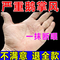 鹅掌风特效脚手癣干裂脱皮手部外用膏，真菌感染汗疱疹止痒抑菌药膏