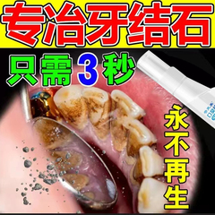 牙结石口喷溶解牙石去牙渍漱口水膏