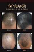 修正防脱生发洗发水育发密发脂溢性秃顶，遗传性产后脱发头发增长液