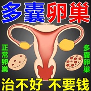 多囊卵巢综合征调理月经不调促排输疏卵助管孕堵神器塞中药泡脚包