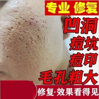 祛痘印痘坑凹洞修复男女士，去毛孔痘疤填充淡化膏消水逗豆再生神器