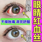 青莓素眼药膏眼睛红血丝修复去除结石，去黄去红血丝缓解眼疲劳眼药