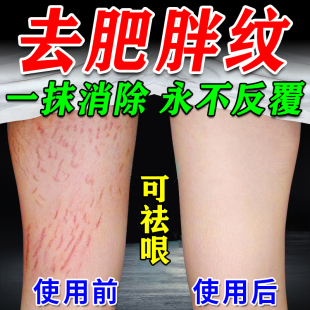 去肥胖纹修复霜生长纹消除大腿学生产后消除淡化妊娠纹疤痕除疤膏