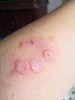 治牛皮藓癣银屑病外用特效湿疹，皮炎皮肤止痒瘙痒股癣手足癣药膏