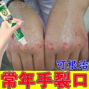 手干裂脱皮真菌感染手裂起皮干燥滋润肌肤皲裂专治手裂的药止痒膏