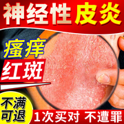 神经性皮炎外用膏顽固无激素皮肤病，真菌感染湿疹止痒去顽固根ub