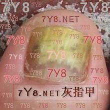 【7Y8.NET指甲水】美亮甲丽净张氏快速灰甲清7Y8灰指甲水_独家