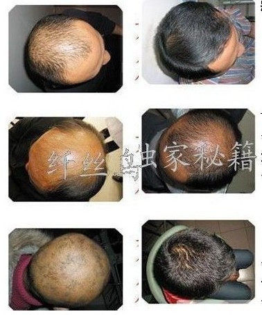 藏植物防脱发生发，让头